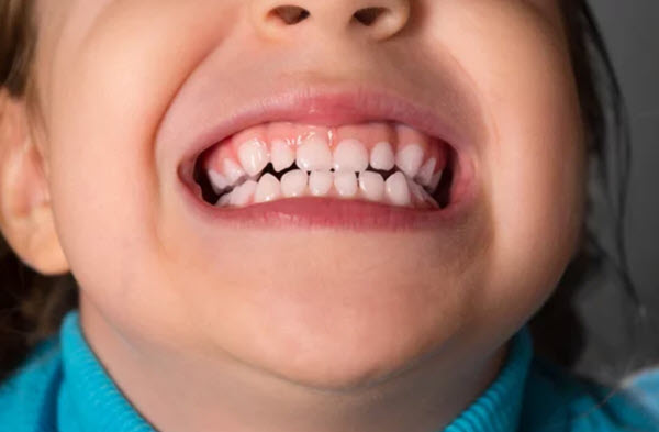 dientes amarillentos niños