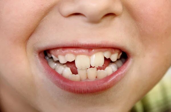 dientes torcidos niños